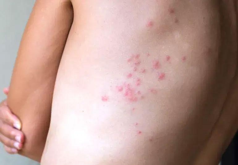 bed bug bites