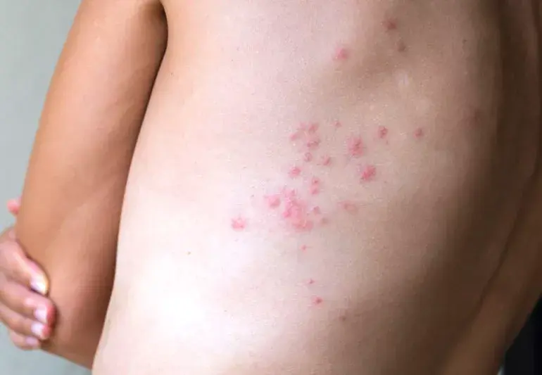 Bed Bug Bites